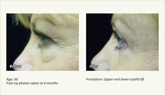 Eyelid Lift Surgery in Plano, TX - Patient 8