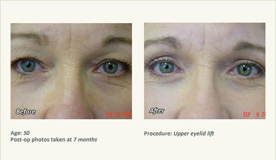 Eyelid Lift Surgery in Plano, TX - Patient 9