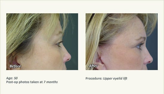 Eyelid Lift Surgery in Plano, TX - Patient 10