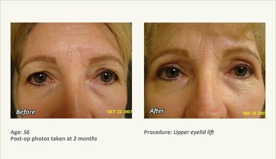 Eyelid Lift Surgery in Plano, TX - Patient 11