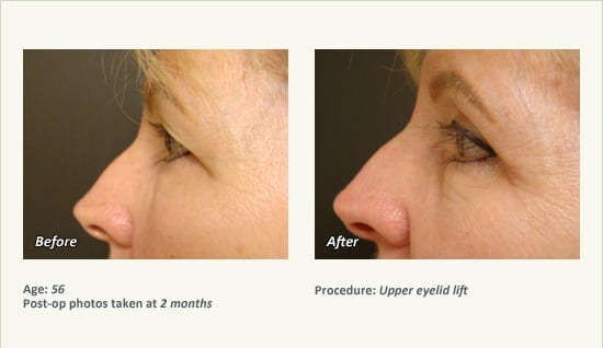 Eyelid Lift Surgery in Plano, TX - Patient 12