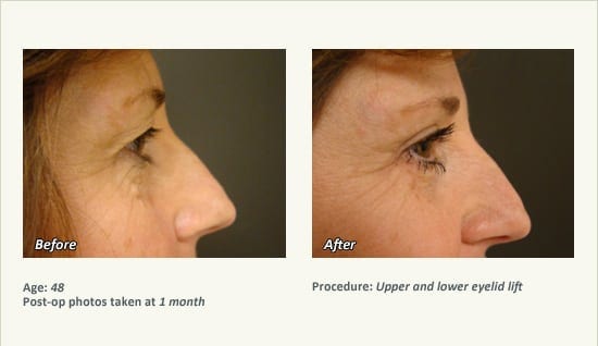 Eyelid Lift Surgery in Plano, TX - Patient 14