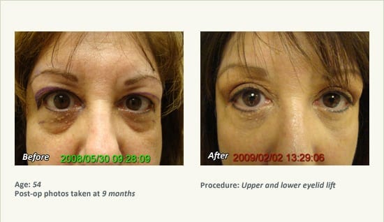 Eyelid Lift Surgery in Plano, TX - Patient 17