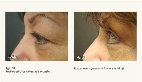 Eyelid Lift Surgery in Plano, TX - Patient 18