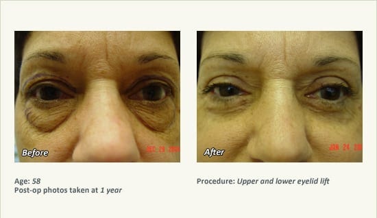 Eyelid Lift Surgery in Plano, TX - Patient 19