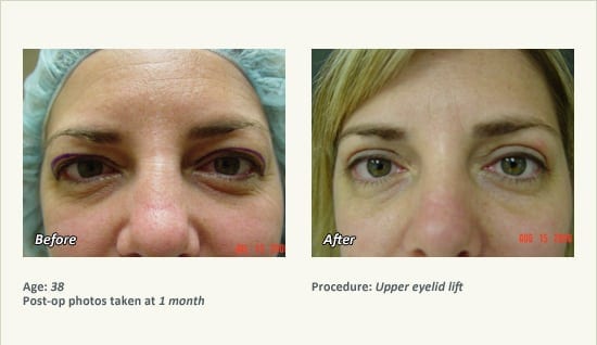 Eyelid Lift Surgery in Plano, TX - Patient 21