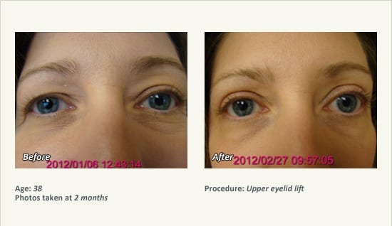 Eyelid Lift Surgery in Plano, TX - Patient 31