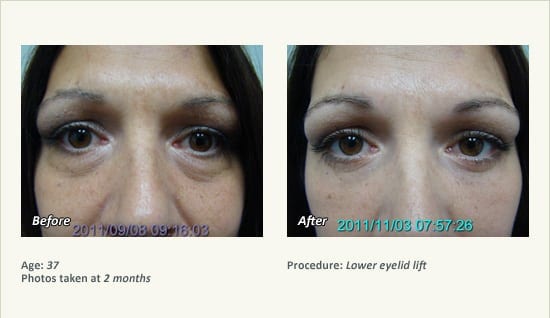 Eyelid Lift Surgery in Plano, TX - Patient 22