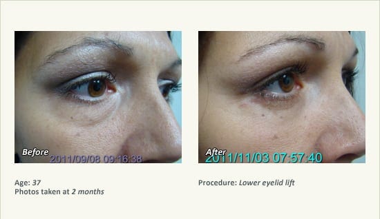 Eyelid Lift Surgery in Plano, TX - Patient 23
