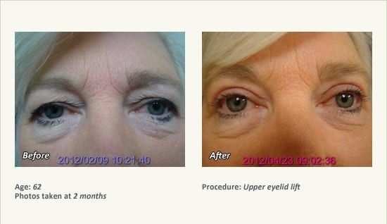 Eyelid Lift Surgery in Plano, TX - Patient 23