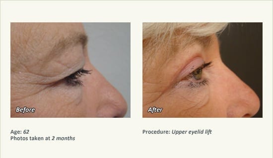 Eyelid Lift Surgery in Plano, TX - Patient 24