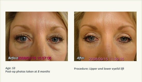Eyelid Lift Surgery in Plano, TX - Patient 25