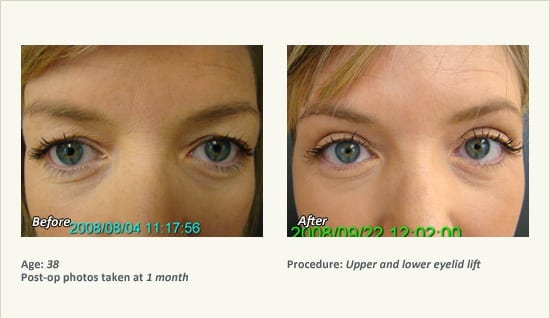 Eyelid Lift Surgery in Plano, TX - Patient 26