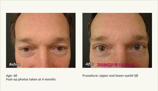 Eyelid Lift Surgery in Plano, TX - Patient 27