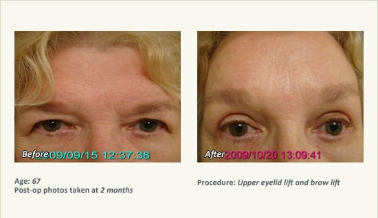 Eyelid Lift Surgery in Plano, TX - Patient 28