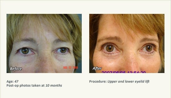 Eyelid Lift Surgery in Plano, TX - Patient 29