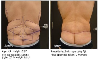 Body Contouring After Weight Loss in Plano, TX - Patient 21