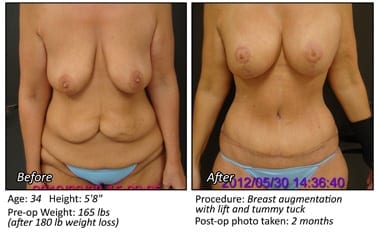 Body Contouring After Weight Loss in Plano & Dallas, TX