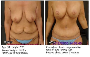 Body Contouring After Weight Loss in Plano, TX - Patient 3