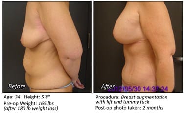 Droopy Breasts After Losing Weight? Consider A Breast Lift