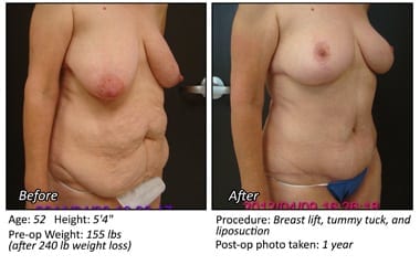 Body Contouring After Weight Loss in Plano, TX - Patient 8