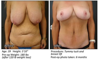 Body Contouring After Weight Loss in Plano, TX - Patient 9