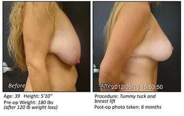 Body Contouring After Weight Loss in Plano, TX - Patient 10