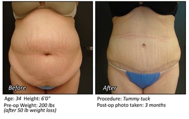 Body Contouring After Weight Loss in Plano, TX - Patient 11