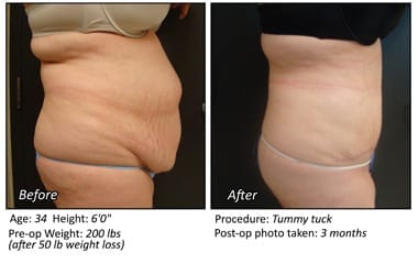 Body Contouring After Weight Loss in Plano, TX - Patient 13