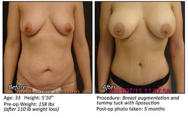 Body Contouring After Weight Loss in Plano, TX - Patient 12