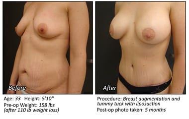 Body Contouring After Weight Loss in Plano, TX - Patient 14