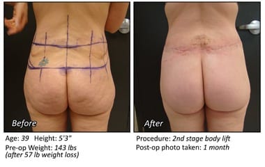 Body Contouring After Weight Loss in Plano, TX - Patient 15