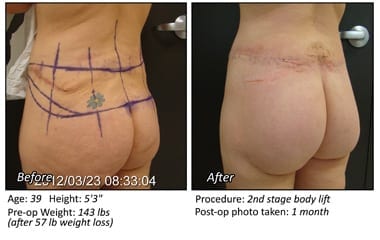 Body Contouring After Weight Loss in Plano, TX - Patient 16