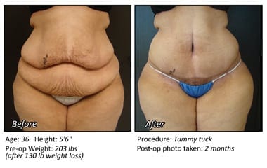 Body Contouring After Weight Loss in Plano, TX - Patient 17