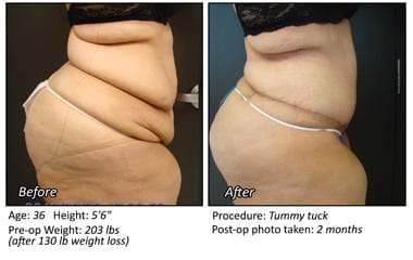 Body Contouring After Weight Loss in Plano, TX - Patient 18