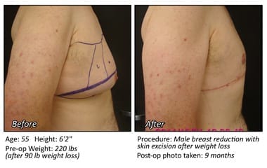Body Contouring After Weight Loss in Plano, TX - Patient 20