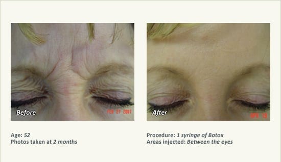 BOTOX® Cosmetic & Dysport® Treatment in Plano & Dallas - Patient 27