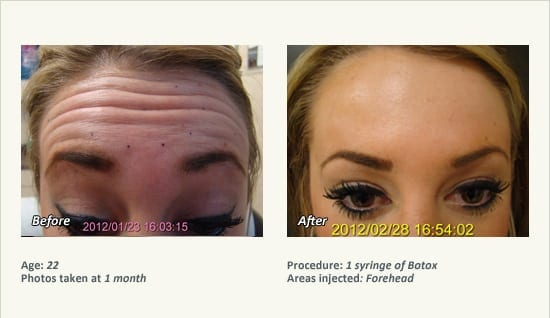 BOTOX® Cosmetic & Dysport® Treatment in Plano & Dallas - Patient 28