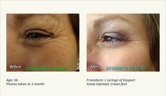 BOTOX® Cosmetic & Dysport® Treatment in Plano & Dallas - Patient 30
