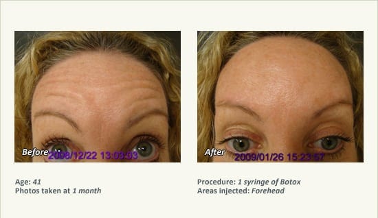 BOTOX® Cosmetic & Dysport® Treatment in Plano & Dallas - Patient 31