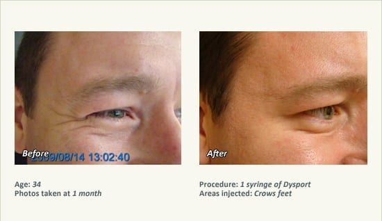 BOTOX® Cosmetic & Dysport® Treatment in Plano & Dallas - Patient 32