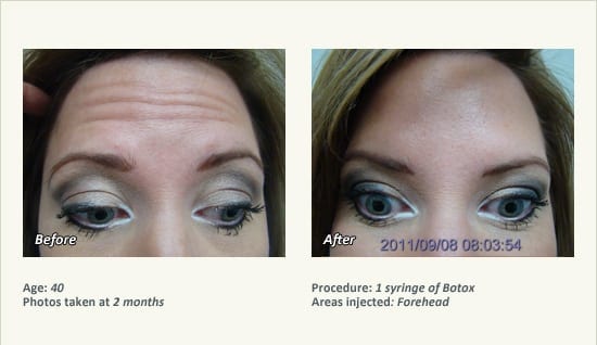 BOTOX® Cosmetic & Dysport® Treatment in Plano & Dallas - Patient 33