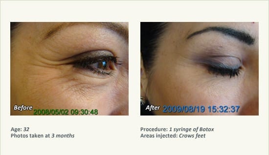BOTOX® Cosmetic & Dysport® Treatment in Plano & Dallas - Patient 34