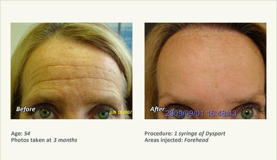 BOTOX® Cosmetic & Dysport® Treatment in Plano & Dallas - Patient 35