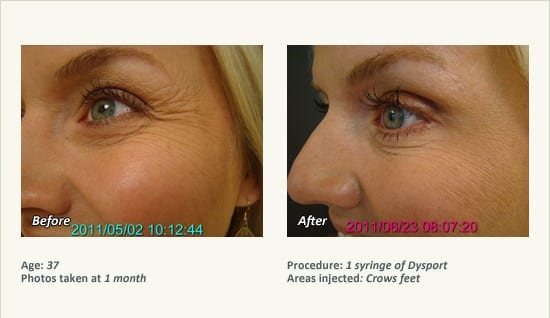 BOTOX® Cosmetic & Dysport® Treatment in Plano & Dallas - Patient 36