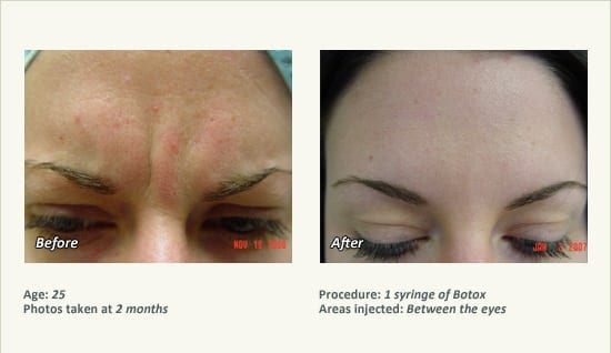 BOTOX® Cosmetic & Dysport® Treatment in Plano & Dallas - Patient 37