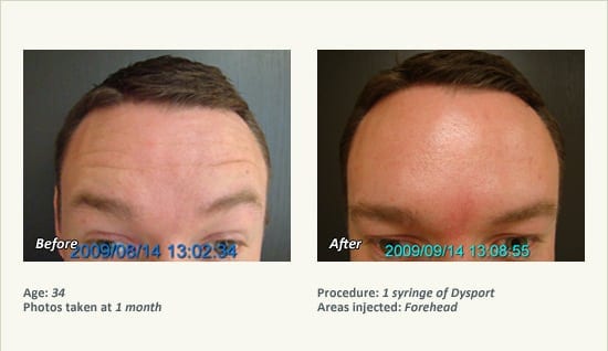 BOTOX® Cosmetic & Dysport® Treatment in Plano & Dallas - Patient 38