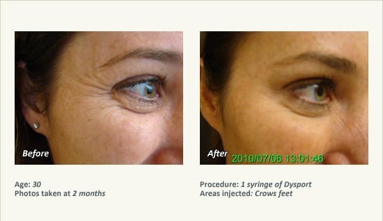 BOTOX® Cosmetic & Dysport® Treatment in Plano & Dallas - Patient 40