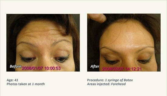 BOTOX® Cosmetic & Dysport® Treatment in Plano & Dallas - Patient 41