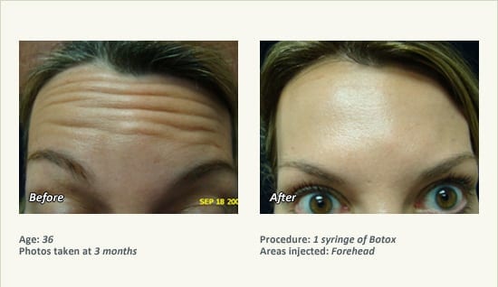 BOTOX® Cosmetic & Dysport® Treatment in Plano & Dallas - Patient 42